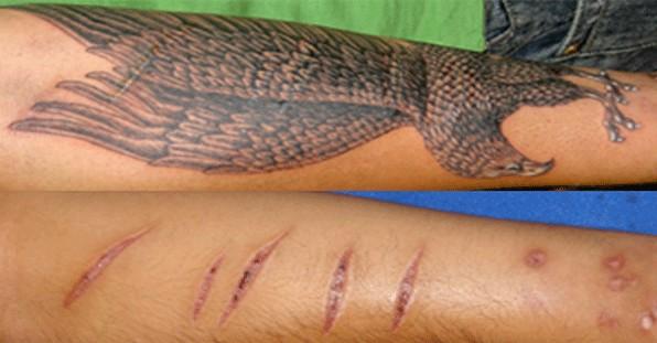 Tatuaggi su cicatrici: i 10 esempi più forti articolo