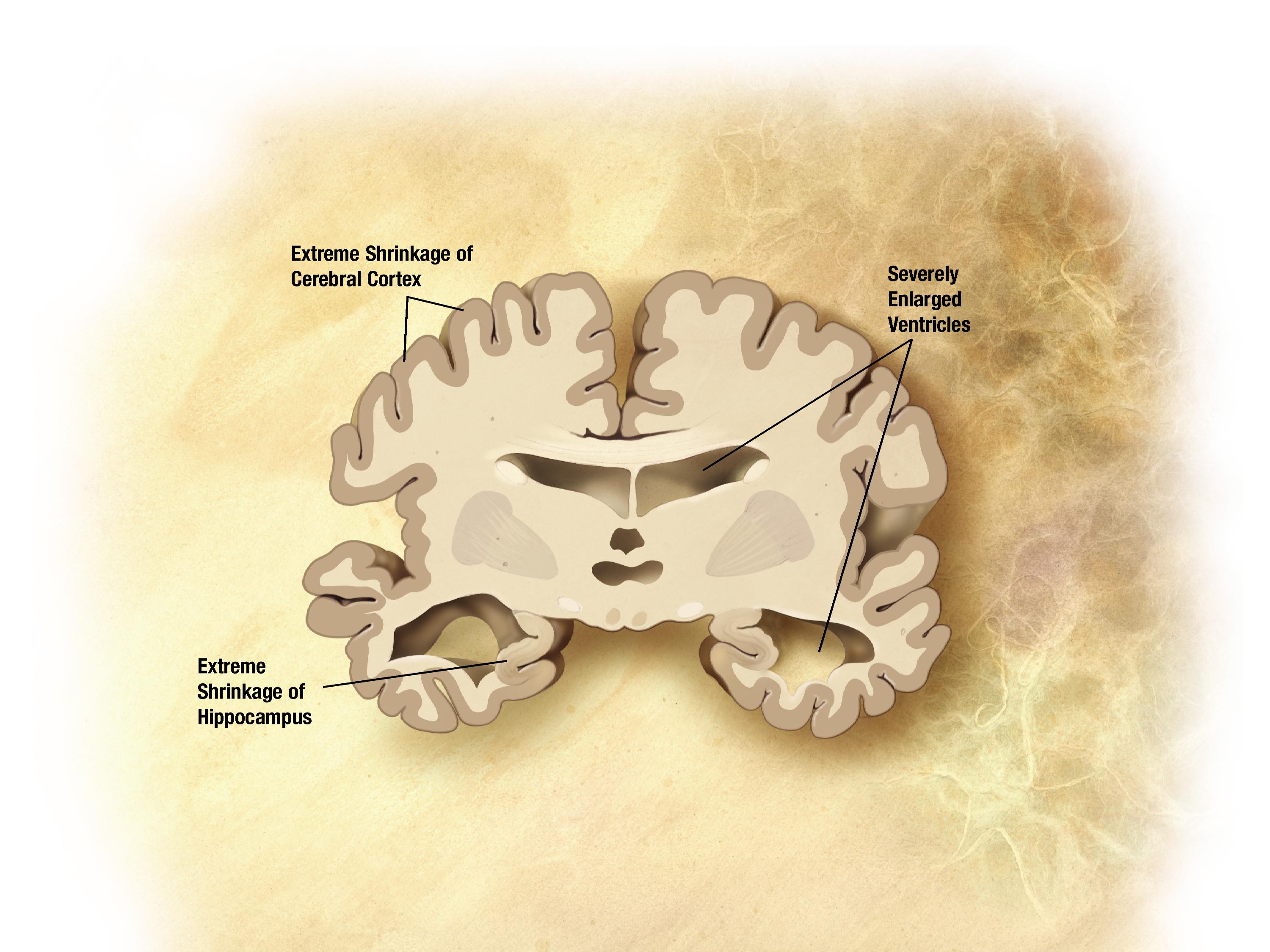 Diagnosi precoce dell'Alzheimer grazie ai ricercatori dell'Università di Bari articolo