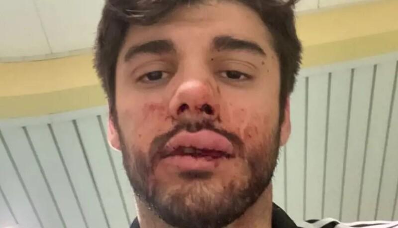 Francesco picchiato per aver difeso una ragazza aggredita dal fidanzato