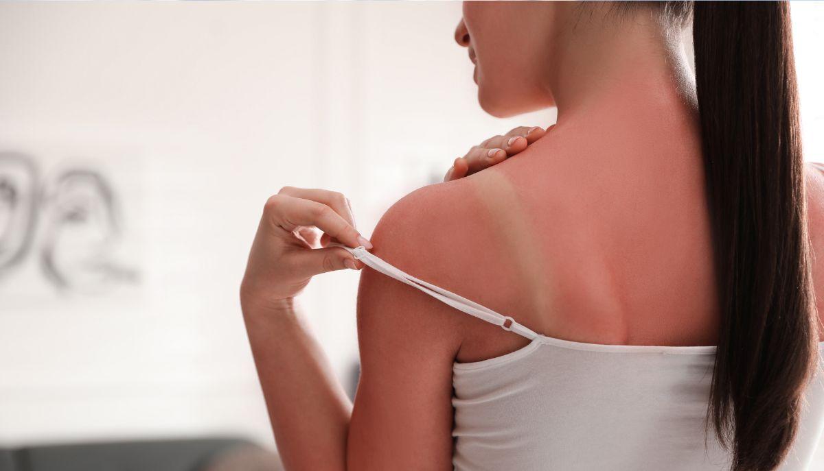 Sunburn Challenge