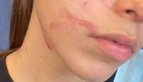 A 13 anni vittima di bullismo, il padre mostra la foto delle botte sui social