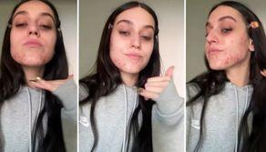 Gaia ci mette la faccia e mostra la sua acne sui social: un gesto all'insegna della body positivity