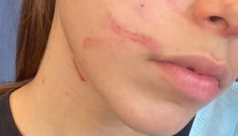 A 13 anni vittima di bullismo, il padre mostra la foto delle botte sui social