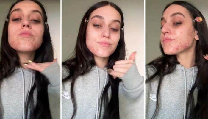 Gaia ci mette la faccia e mostra la sua acne sui social: un gesto all'insegna della body positivity